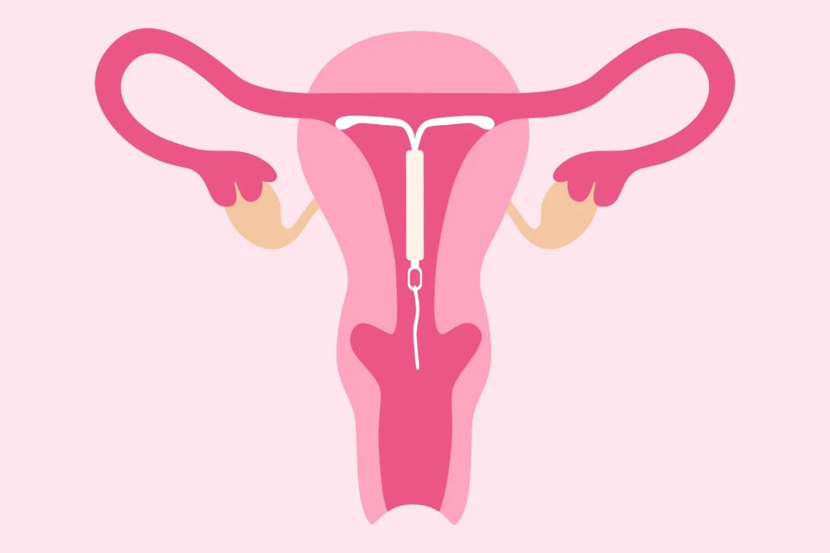 Estudo da Unicamp revela que 81% das mulheres sentem dor moderada a intensa na inserção do DIU, superando projeções do Ministério da Saúde, segundo Metrópoles