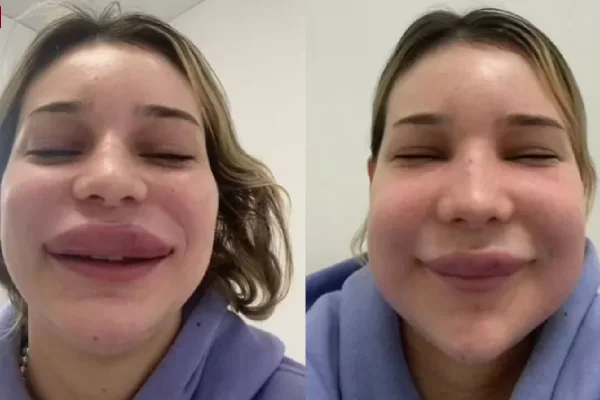 Montagem com duas fotos colorias de uma mulher branca com os lábios inchados usando uma roupa azul