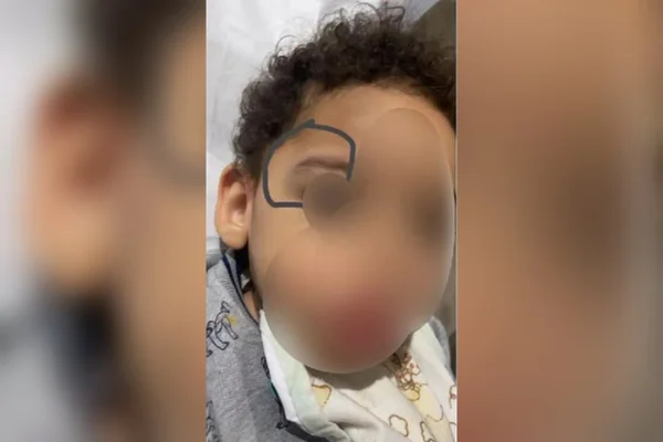 Mãe relata que menino se machucou na escola