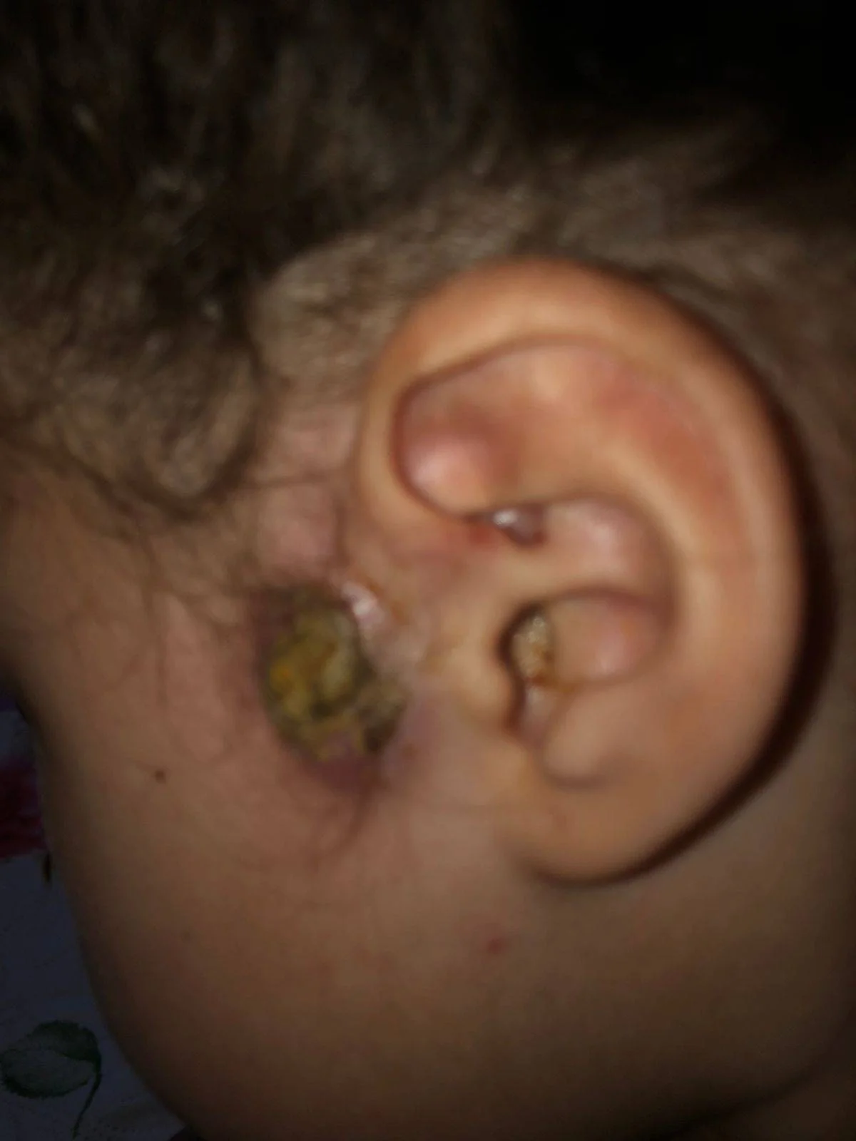 Mãe luta contra o tempo para conseguir operar filha com infecção grave - imagem 2 Mãe luta contra o tempo para conseguir operar filha com infecção grave - imagem 2