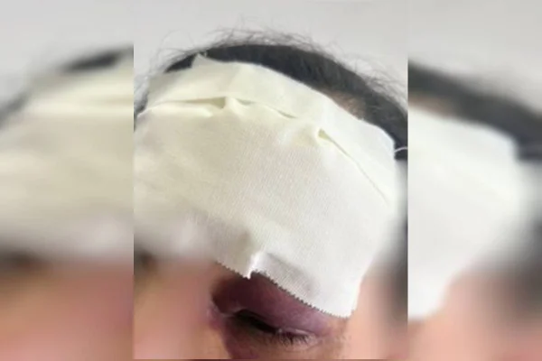 Mulher tem rosto deformado após agressão de companheiro ciumento