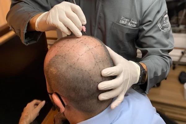 Tattoo na cabeça? Conheça alternativa acessível ao transplante capilar