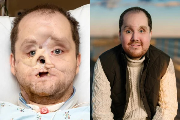 Foto de Derek Pfaff antes e depois do transplante de rosto. Metrópoles