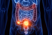 Doses de café pode reduzir em 30% risco de câncer de intestino