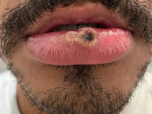 Foto colorida de homem com monkeypox