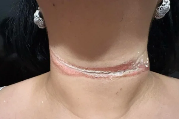 Foto de mulher que quase foi enforcada por fio de internet solto em MS