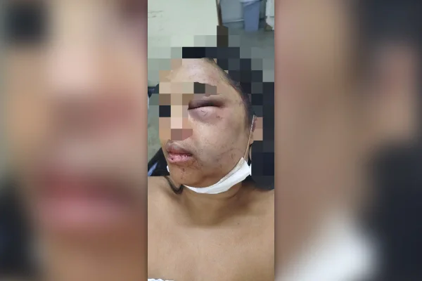 Mulher sofre grave agressão, tem maxilar fraturado e denuncia ex-companheiro