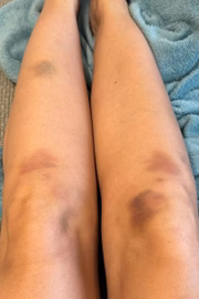 Hematomas nas pernas Hematomas nas pernas
