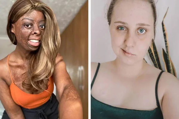 Foto colorida de duas mulheres com lesões na face