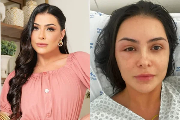 Fotomostra a influencer Cris Felix, que fez tratametno para a queda de cabelo e acabou tendo uma alergia grave - Metrópoles
