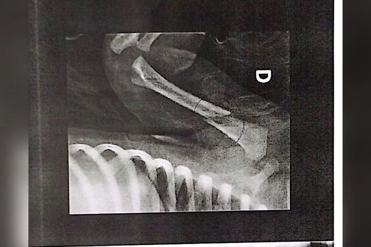 Bebê é levada ao hospital com ossos quebrados e pais são presos - imagem 5 Bebê é levada ao hospital com ossos quebrados e pais são presos - imagem 5