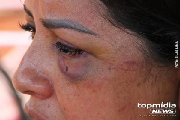 Imagem colorida de Luiza com um dos olhos roxo - Metrópoles