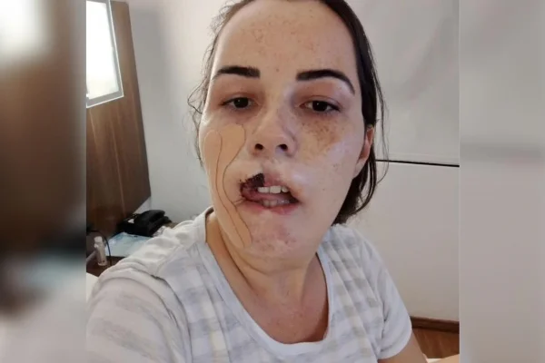 Mulher que perdeu lábio após hamonização com PMMA faz nova cirurgia usando enxerto de língua