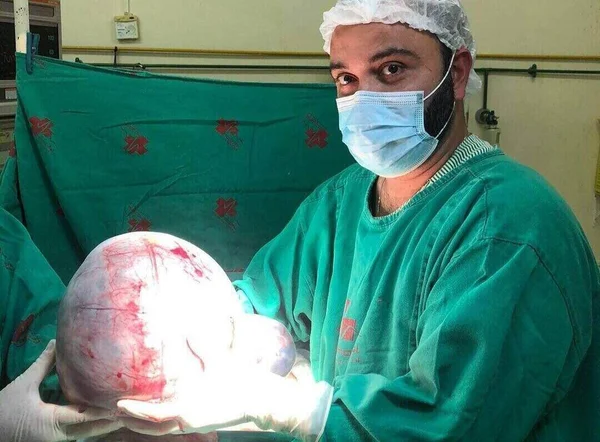 O ginecologista e obstetra Marino Oliveira afirmou que esse é o maior cisto de ovário que ele já viu
