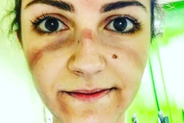 medica mostra hematomas no rosto