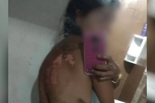 mulher sofre queimaduras nas costas em goiás, após companheiro jogar óleo quente