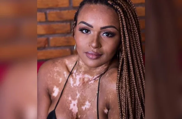 Na imagem colorida, uma mulher está posicionada no centro. Ela tem longos cabelos escuros, possui vitiligo na pele e olha seriamente para a câmera