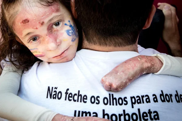 Imagem colorida - criança com Epidermólise Bolhosa - Metrópoles