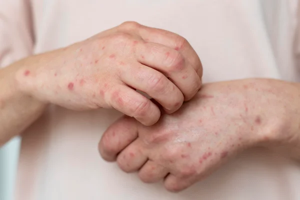 Foto colorida de mãos humanas com manchas - Metrópoles