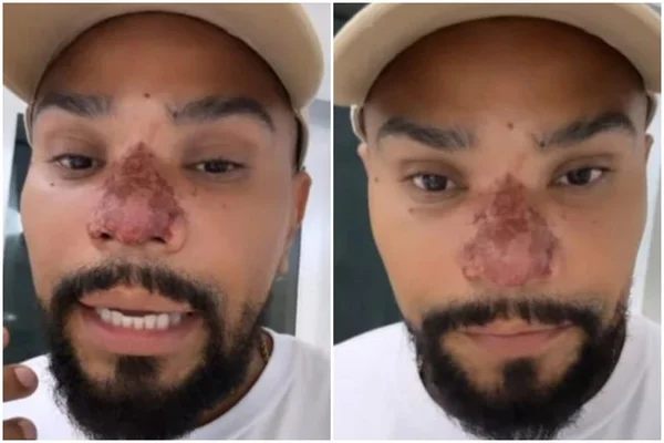 Fotos do rosto de Naldo Benny. Ele é um homem de pele negra, está de boné branco, tem olhos pretos, barba e cavanhaque pretos e está com o nariz vermelho por conta de uma necrose - Metrópoles