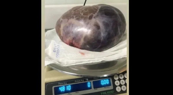 imagem colorida tumor 5 kg mulher mg