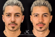 Biel compartilhou resultado de harmonização facial