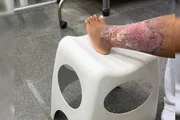 Kenia Alves sofreu queimaduras nas pernas e precisa voltar ao hospital diariamente Kenia Alves sofreu queimaduras nas pernas e precisa voltar ao hospital diariamente