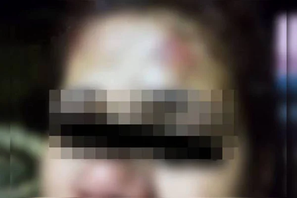 Foto colorida e borrada de uma lesão na testa da mulher agredida pelo companheiro