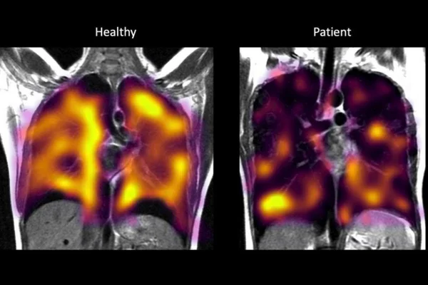 Estudo encontra danos pulmonares ocultos em pacientes com Covid longa