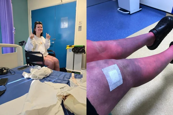 Imagem colorida de mulher com doença rara na cadeira de rodas e suas pernas roxas - Metrópoles