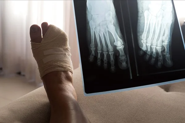 Com 9 dedos no pé, homem passa por cirurgia para tirar extras