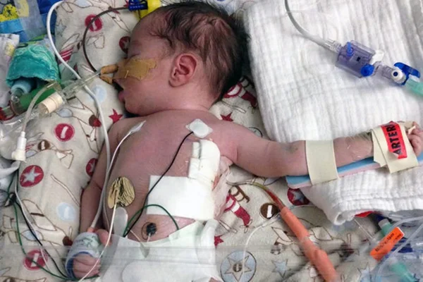 Bebê pega herpes após mãe beijá-lo e fica à beira da morte