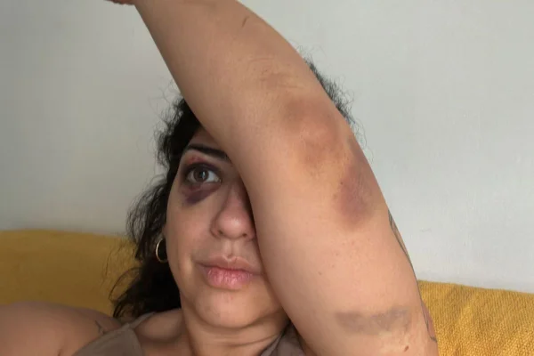 Dona do bar teria acusado a publicitária de estar dando em cima do marido dela. Vítima diz ter sofrido socos e arranhões pelo rosto e corpo - Metrópoles