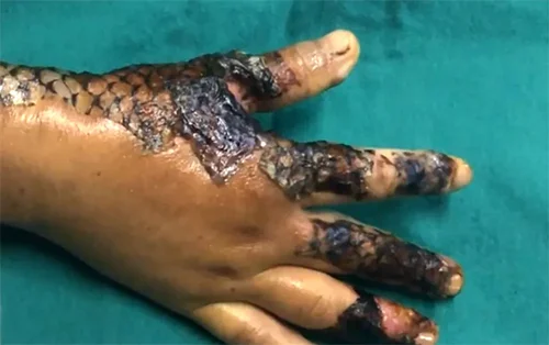 SP: hospital usa pele de tilápia para tratar crianças com dedos colados