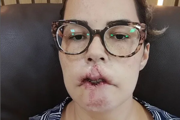 Mulher de óculos com cicatriz nos lábios - Metrópoles