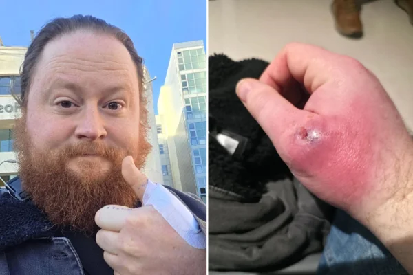 Foto colorida de Chris Keegan, paciente que teve que fazer cirurgia após picada na mão - Infecção após picada suspeita de aranha leva homem a cirurgia na mão - Metrópoles.