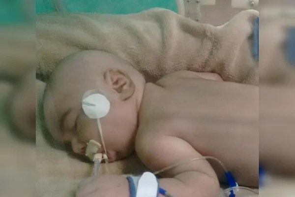 Recém-nascida aguarda há um mês por cirurgia no coração no DF