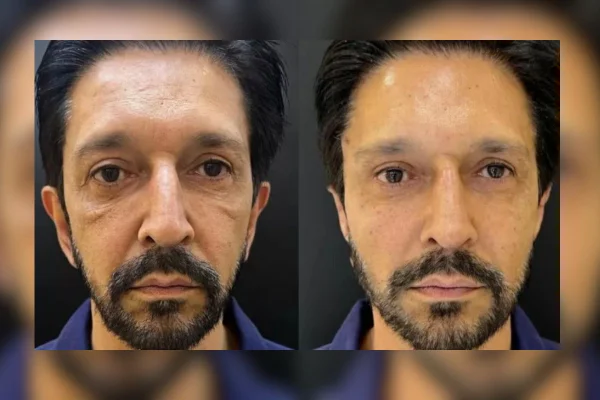 Imagens coloridas mostram o antes e depois de um homem branco e com barba após harmonização facial