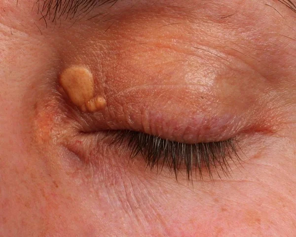Xanthelasma