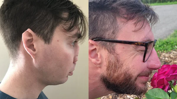 Foto mostra Andrew Koplove, homem que passou por cirurgia para reconstruir o nariz após ser atacado por cachorro