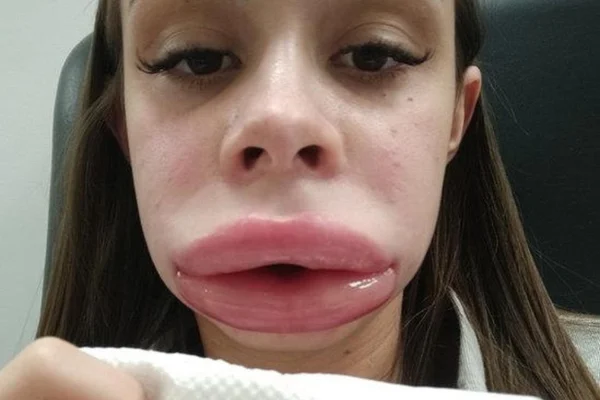 Jovem empresária descobre doença rara após preenchimento labial