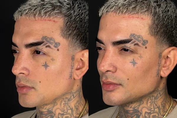 MC Guimê exibe resultado de harmonização facial. Veja antes e depois - destaque galeria MC Guimê exibe resultado de harmonização facial. Veja antes e depois - destaque galeria