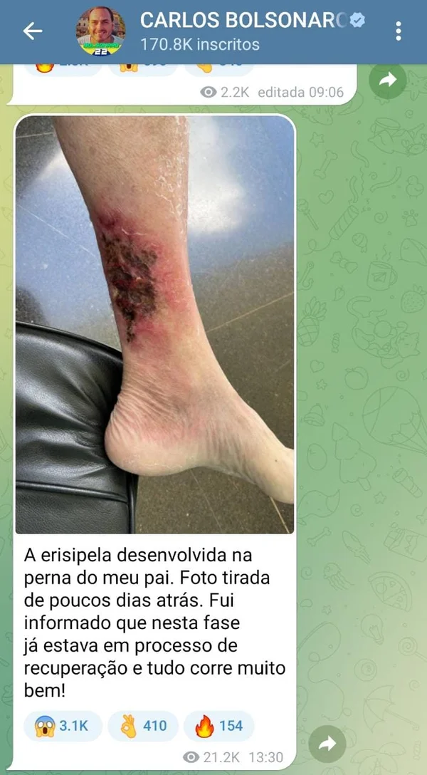 Bolsonaro erisipela