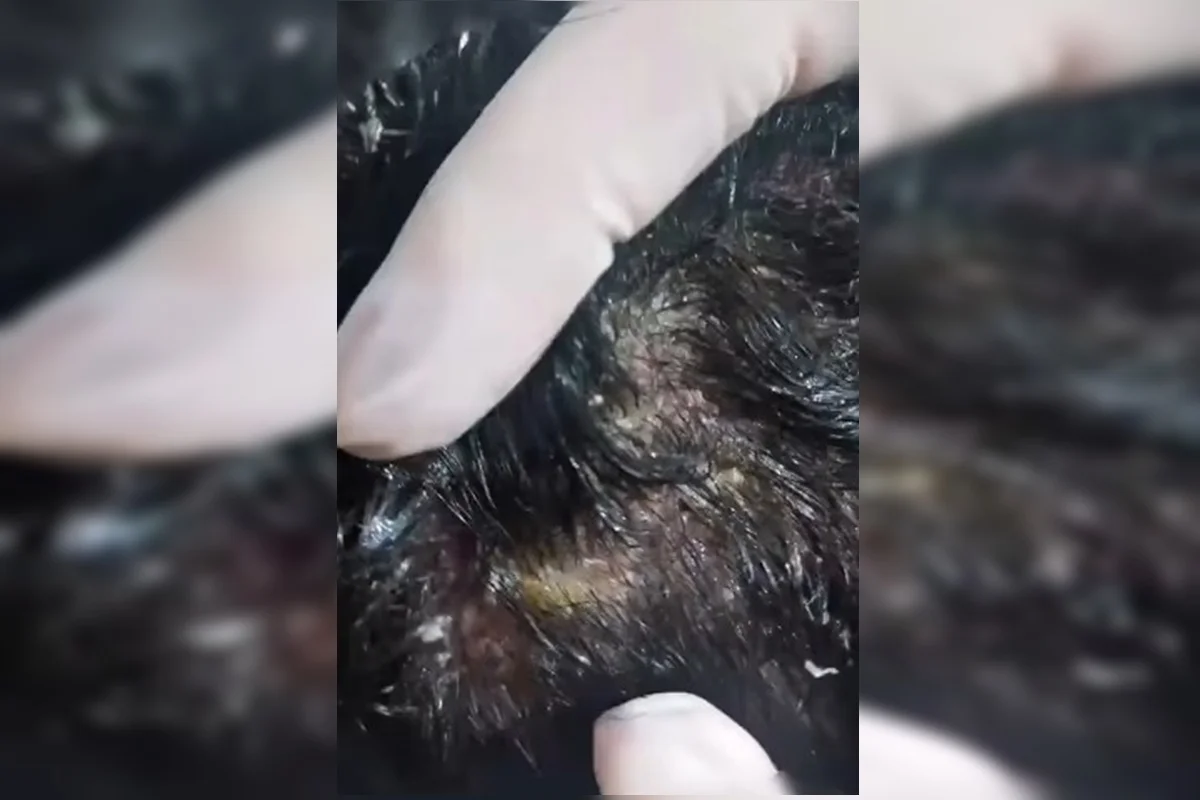 Outra foto da lesão cabeça de uma das crianças Outra foto da lesão cabeça de uma das crianças