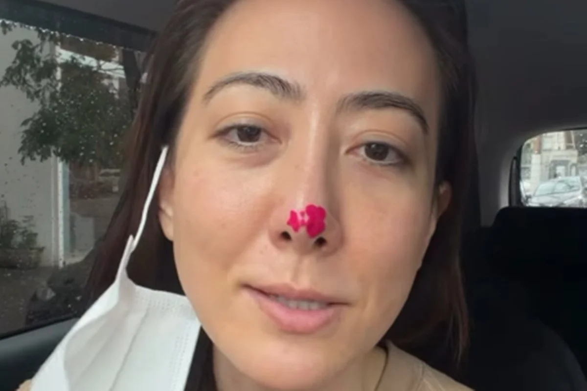 Ju Massaoka revelou que está com uma ferida na ponta do nariz e voltou a fazer o tratamento Ju Massaoka revelou que está com uma ferida na ponta do nariz e voltou a fazer o tratamento