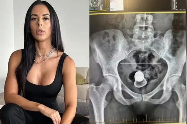 Alicia Davis realiza raio-x e procedimento médico para retirada de plug anal