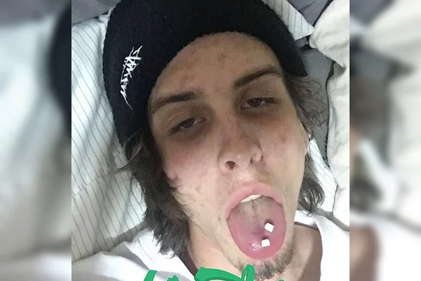 Jovem viraliza com fotos antes e depois de largar drogas: “Finalmente vivo”