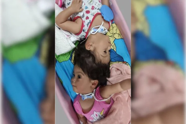 As gêmeas siamesas Heloísa e Helena nasceram unidas pela cabeça. Elas são acompanhadas pelo Hospital de Ribeirão Preto, no interior de SP - Metrópoles