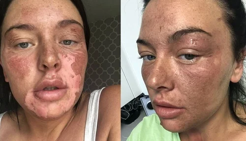 Mãe tem rosto queimado na cozinha após tentar truque do TikTok