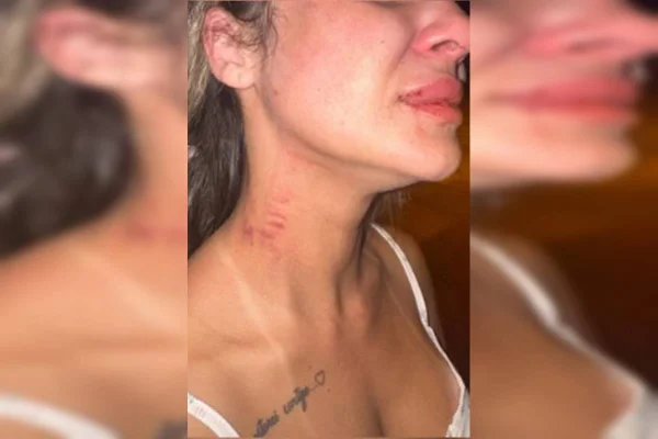 Agressão brutal: influencer mostra lesões após ser espancada por ex